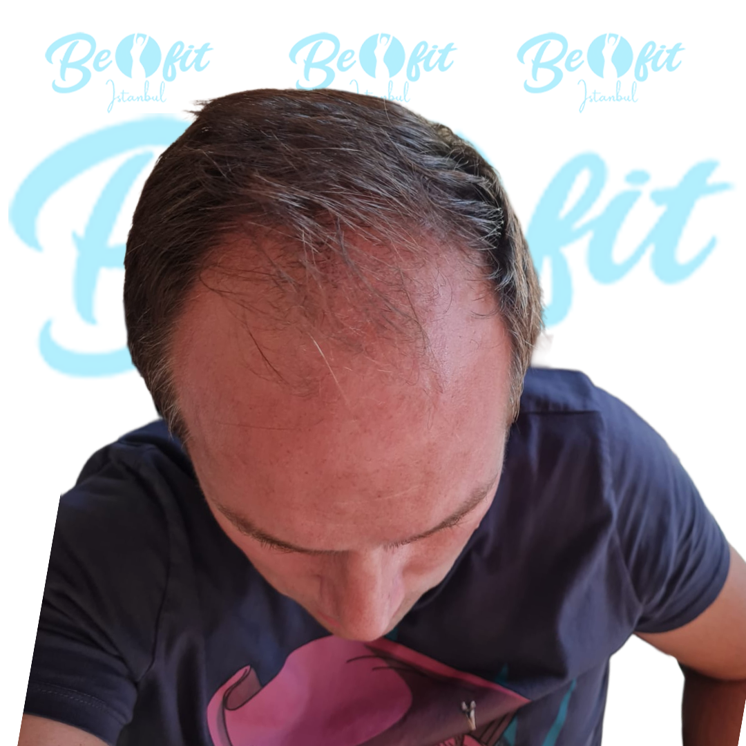 Before Hair Transplant