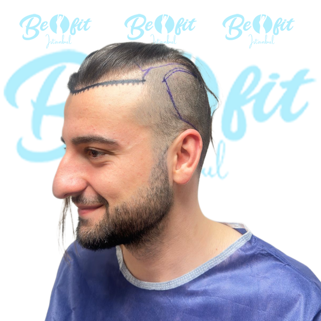 Hairline Before Treatment
