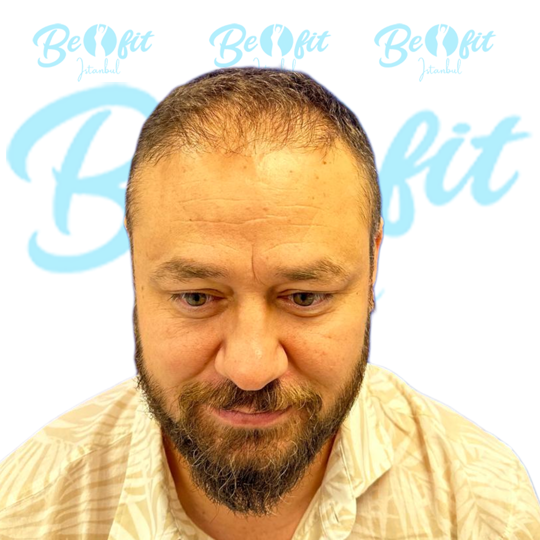 Before Hair Restoration