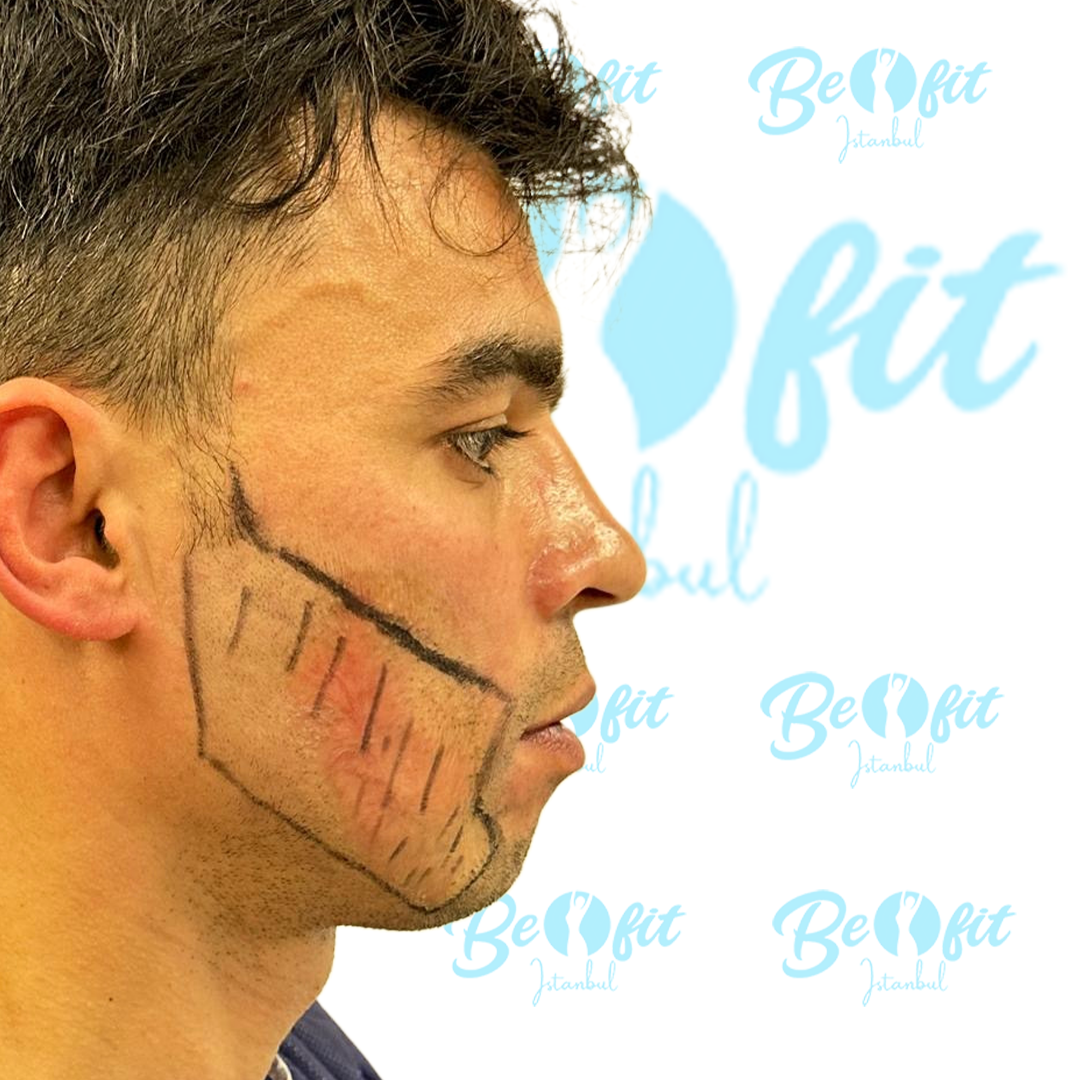 Before Beard Transplant